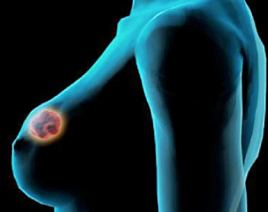 5 самых главных симптомов рака молочной железы